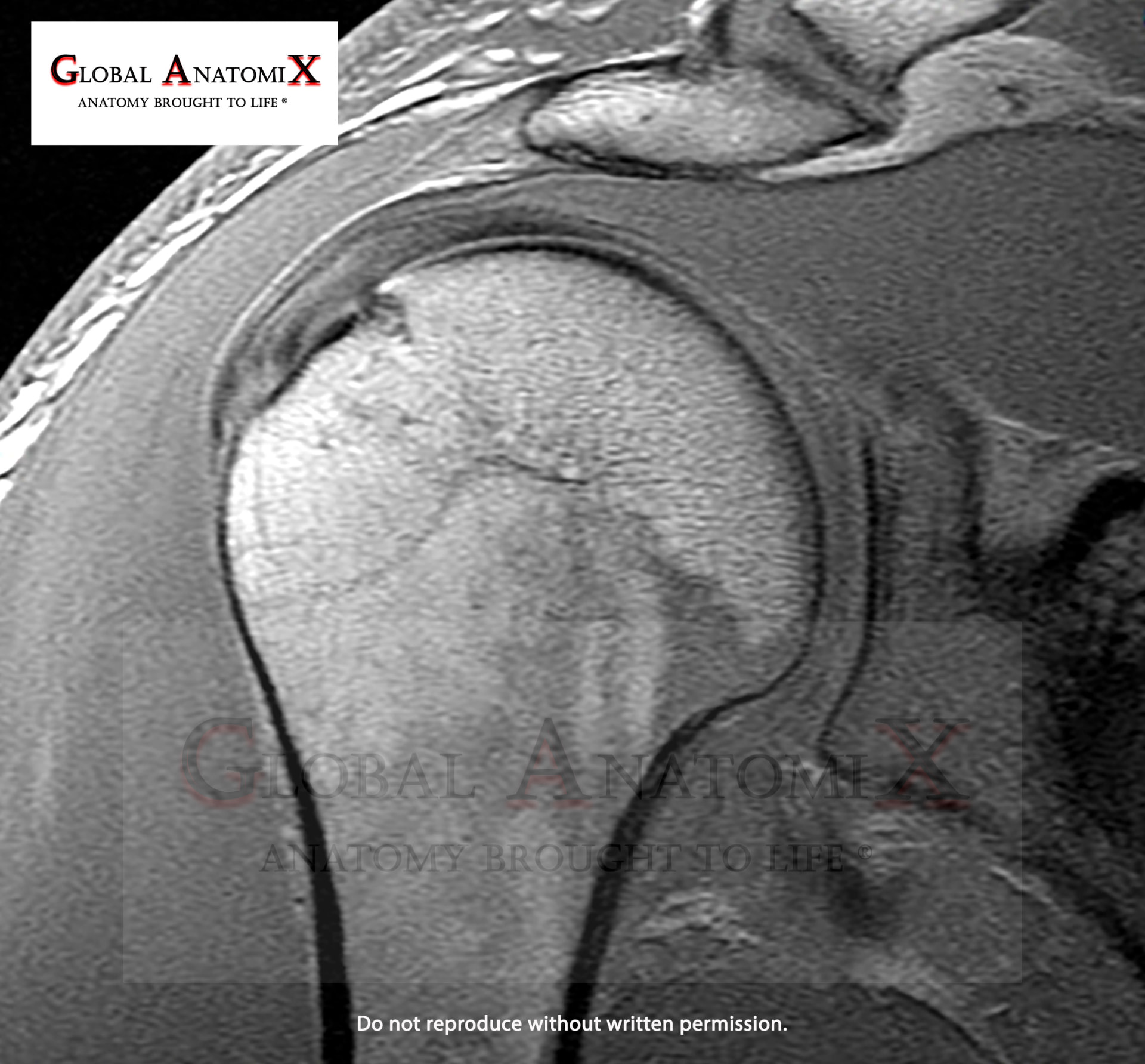 Shoulder, MRI