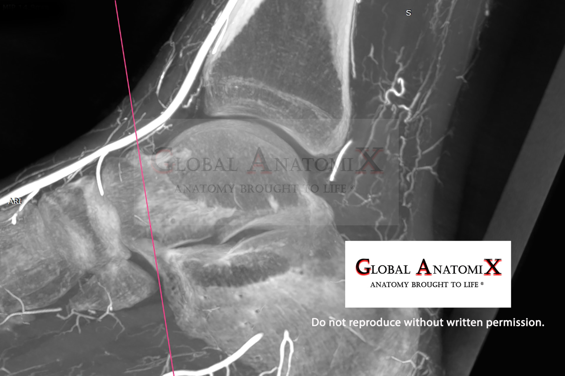 Posterior ankle