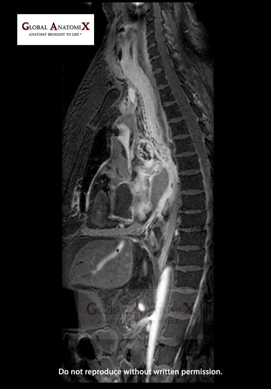 Chest and abdomen with gadolinium, sagittal view