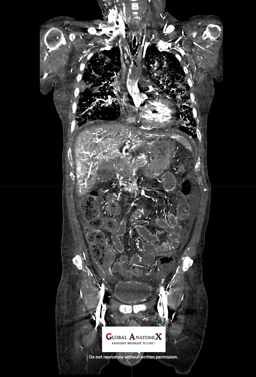 Abdominal vasculature, coronal view