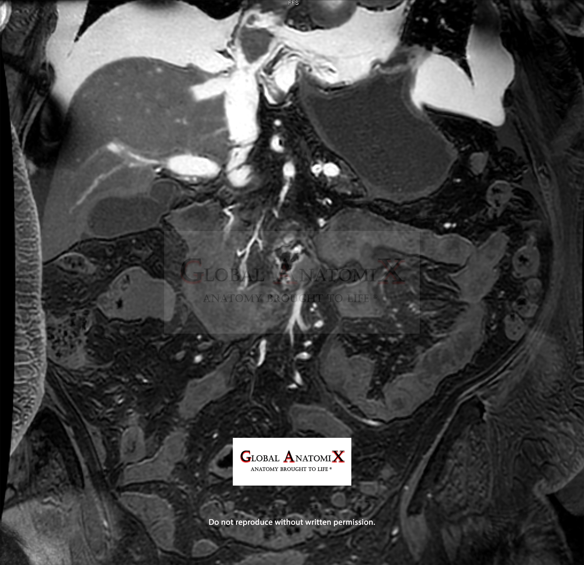 Abdomen MRI with gadolinium contrast