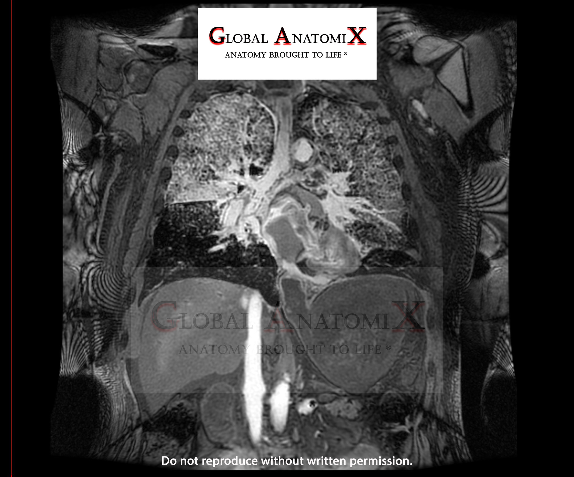 Chest and abdomen with gadolinium, view 2