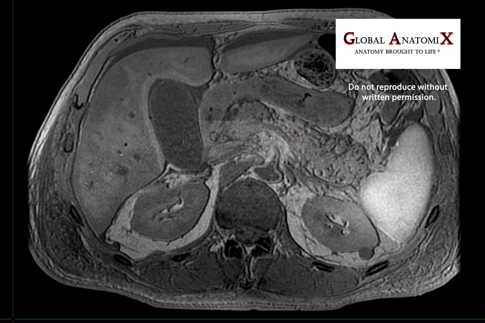 Liver and kidneys, transverse MRI