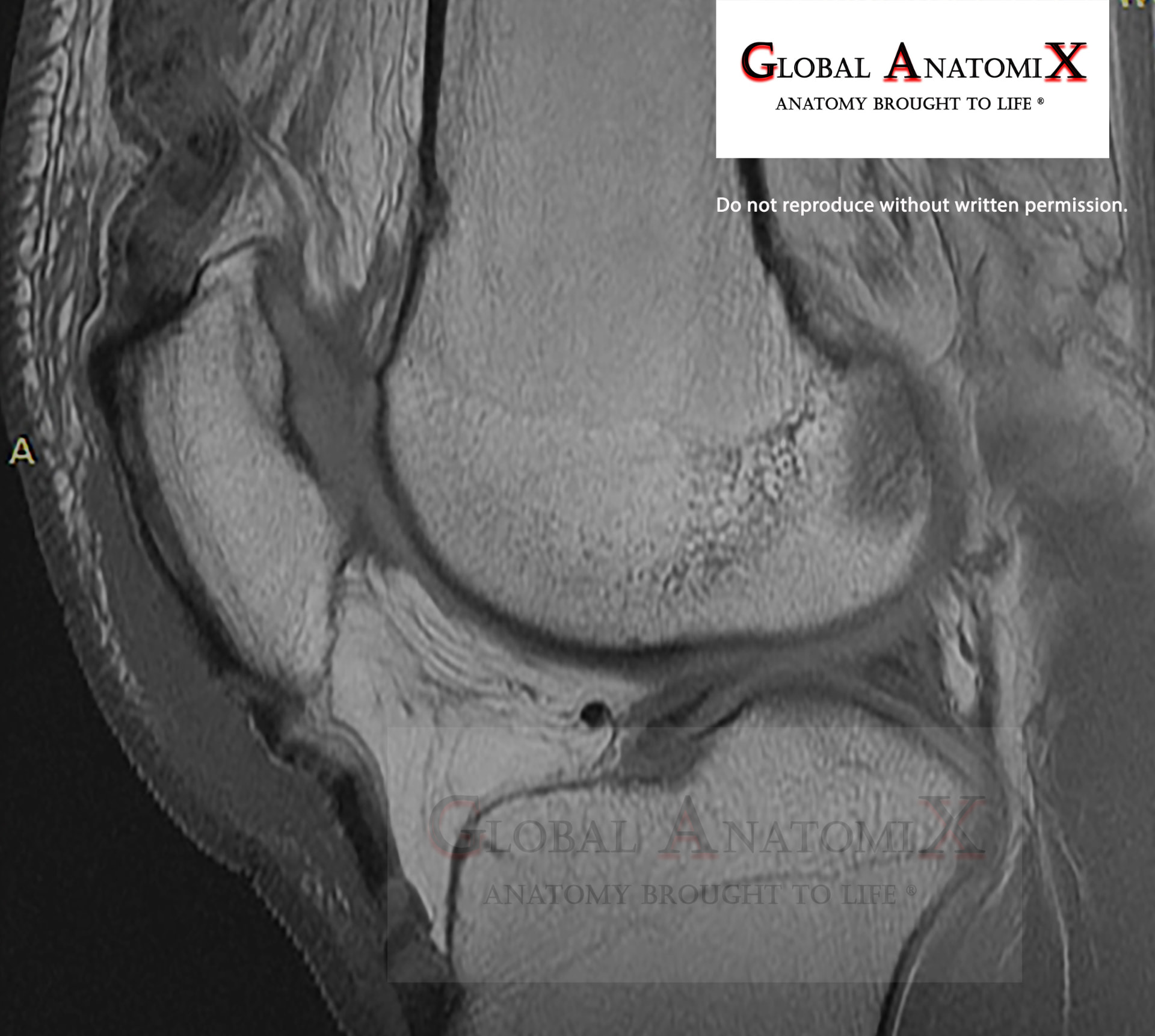 Stifle, MRI