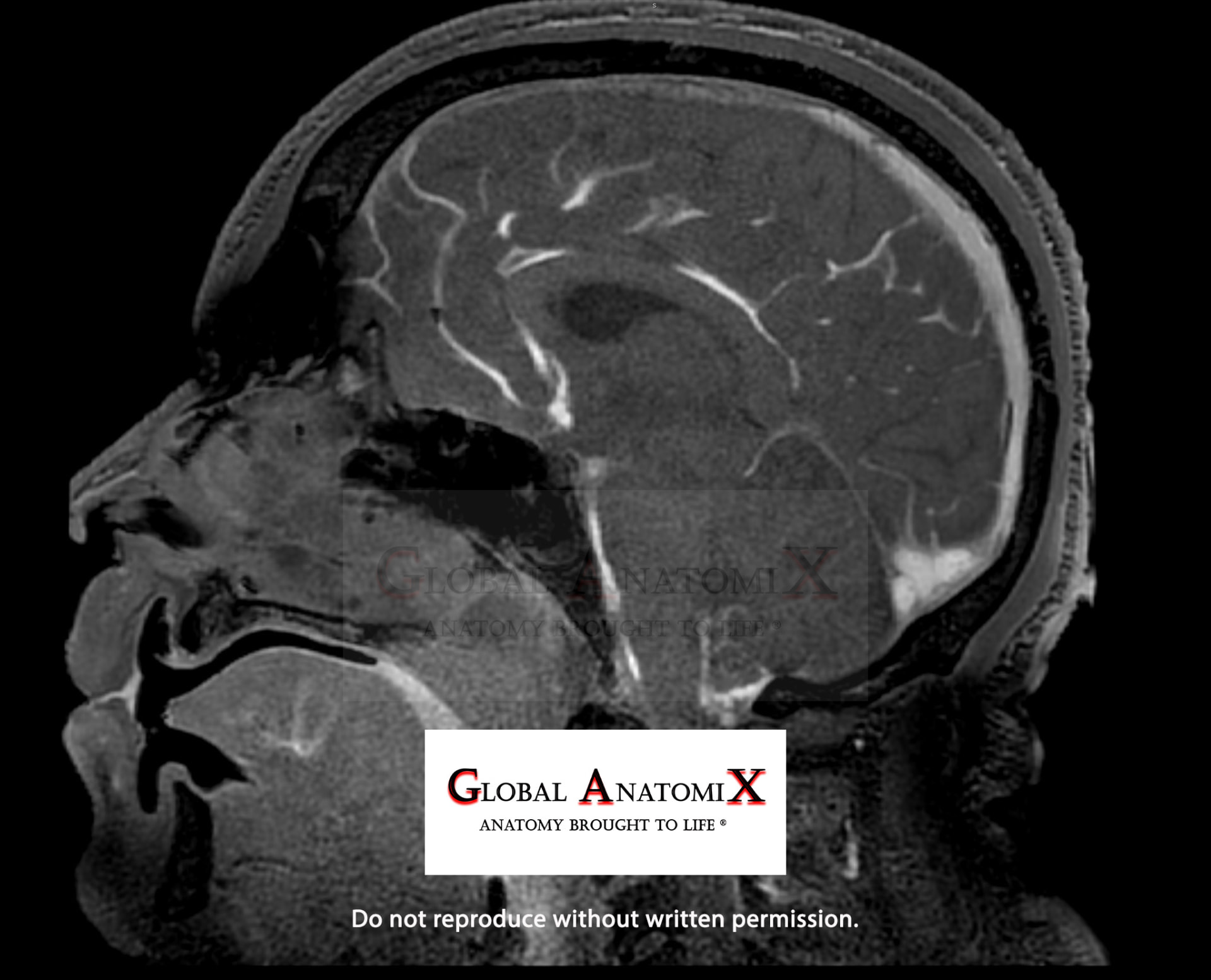 Brain with gadolinium, sagittal view
